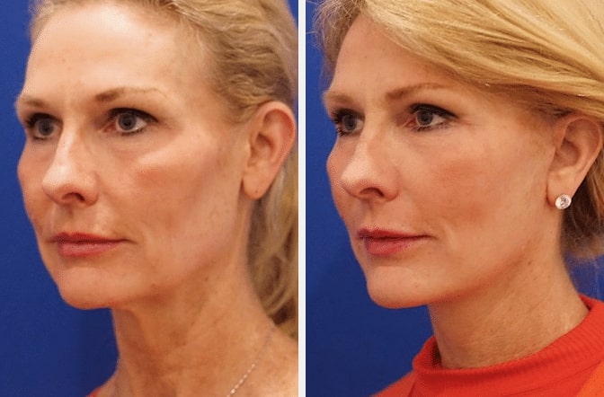 Oblique view of Mini Facelift 6-months post-op