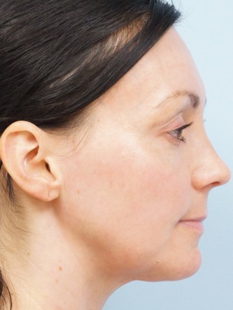 Fractional CO2 Laser Skin Resurfacing2*