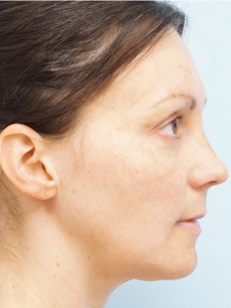 Fractional CO2 Laser Skin Resurfacing2*