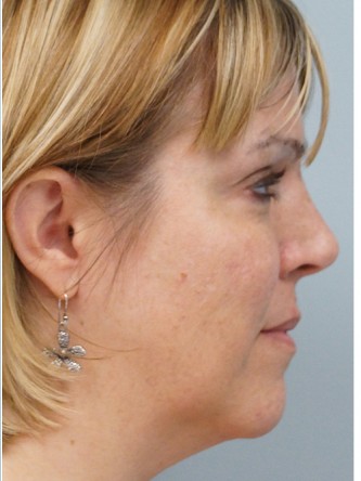 Cheek Augmentation using Voluma*