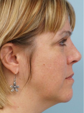 Cheek Augmentation using Voluma*