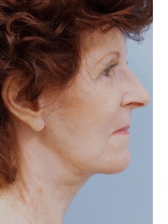 Facelift, Necklift, Platysmaplasty, ERB:YAG Laser Resurfacing*