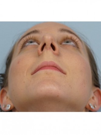 Nasal Hump Endonasal Rhinoplasty*