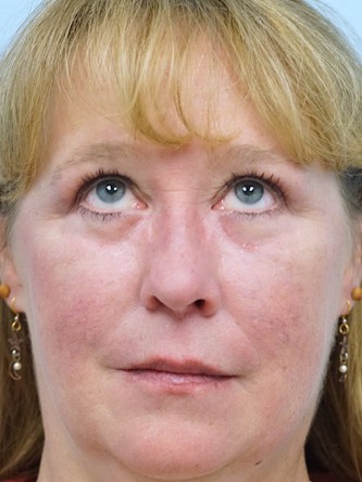 Upper and Lower Eyelid Blepharoplasty*