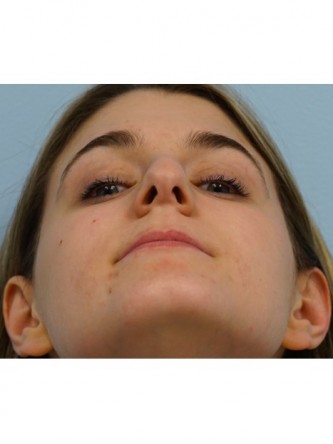 Droopy Tip Endonasal Rhinoplasty*