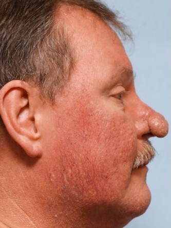 Rhinophyma*