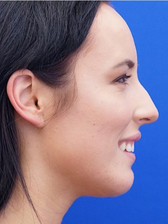Chin Implant and Upper Lip Filler*