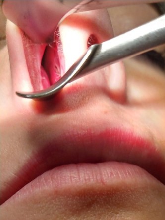 Repair of Nasal Septal Perforation*
