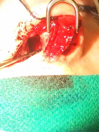 Repair of Nasal Septal Perforation*