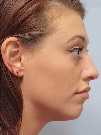 Cupid’s Bow Enhancement by Juvederm*