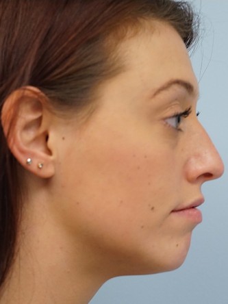 Cupid’s Bow Enhancement by Juvederm*