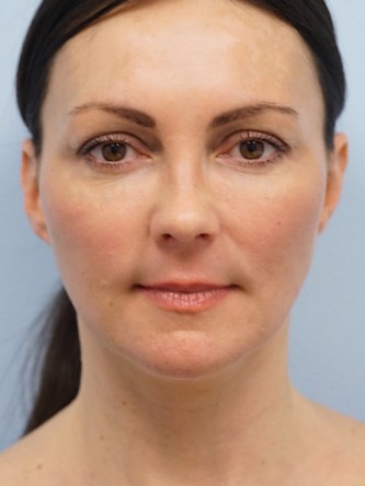 Mini Lift, Laser Resurfacing, Facial Filler*