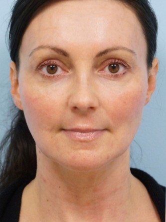 Mini Lift, Laser Resurfacing, Facial Filler*