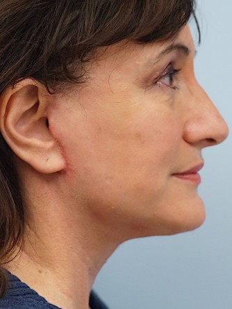 Mini Face and Neck Lift*