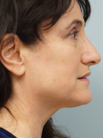 Mini Face and Neck Lift*