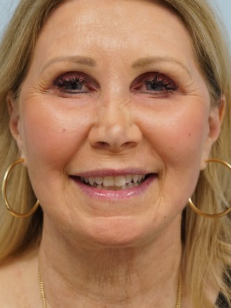 Endoscopic Browlift, Facial Fat Graft, Full Facelift, Fractional CO2 Laser*