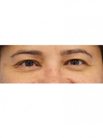 Right Ptosis Repair*