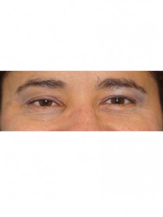 Right Ptosis Repair*