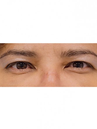 Fat Grafting to Lower Eyelid*