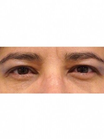 Fat Grafting to Lower Eyelid*