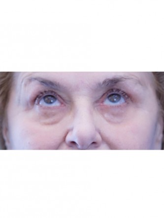 Eyelid Rejuvenation and Fat Transfer to Cheek*
