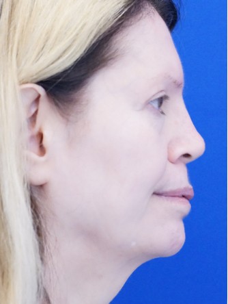 Sunken Nasal Base and Upper Lip*