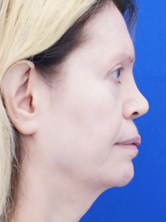 Sunken Nasal Base and Upper Lip*