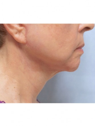 Neck Lift*