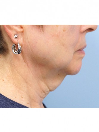 Neck Lift*