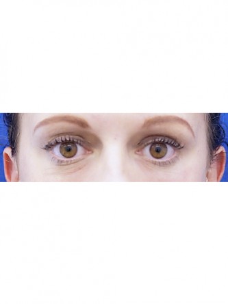 Lower Eyelid Hollow*