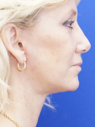 Facelift, Eyelid Skin Trim, Facial Fat Transfer*