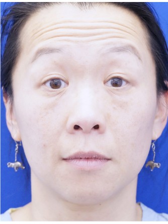 Unilateral Ptosis Repair*