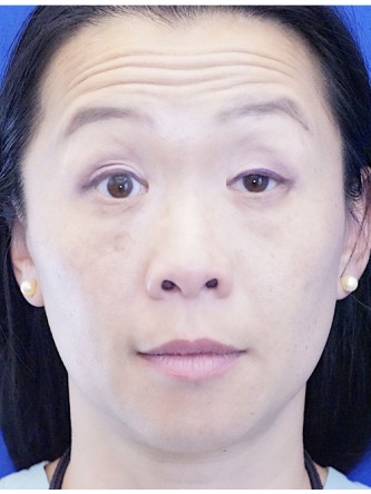 Unilateral Ptosis Repair*