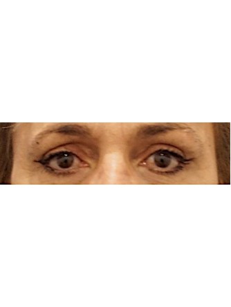 Endoscopic Browlift and Eyelid Skin Excess*
