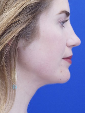 Chin LipoSculpture*