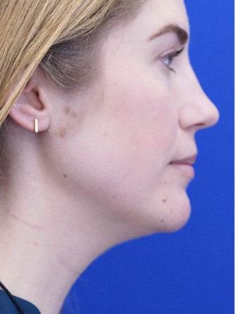 Chin LipoSculpture*