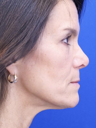 Nasal Tip Deformity