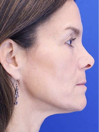 Nasal Tip Deformity