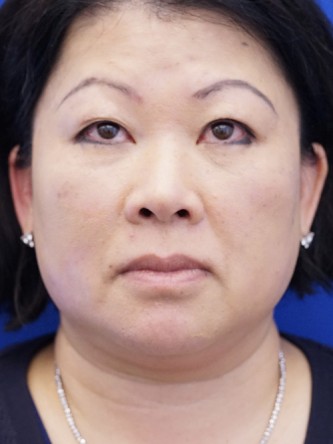 Asian Blepharoplasty