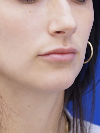 One Year Lip Filler Result