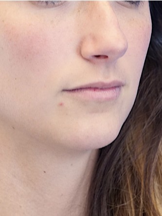 One Year Lip Filler Result