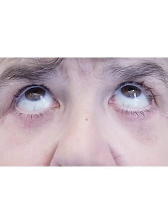 Lower Eyelid Fat Reposition