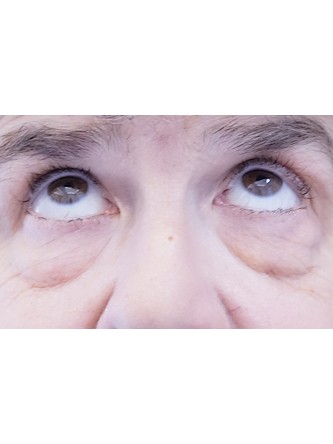 Lower Eyelid Fat Reposition