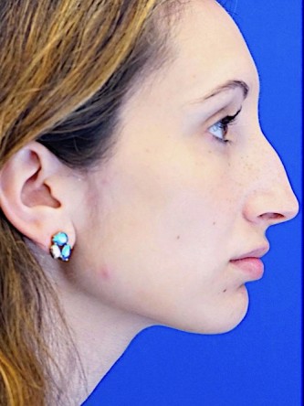 Nasal Profile Aesthetics