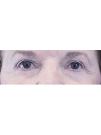 Lower Blepharoplasty with Canthopexy