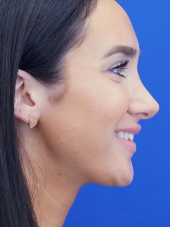 Nasal Hump Closed Rhinoplasty