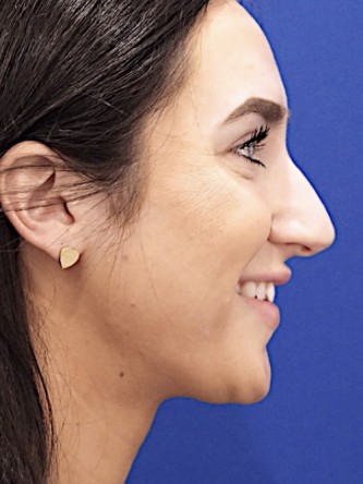 Nasal Hump Closed Rhinoplasty