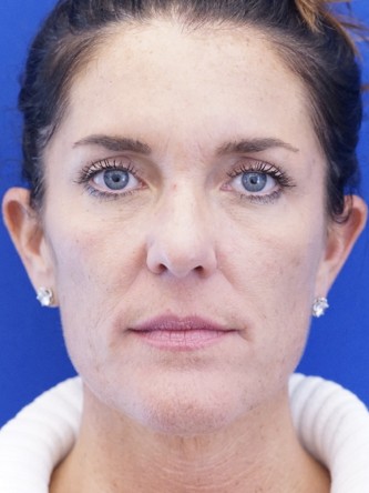 Upper Skin Only Blepharoplasty