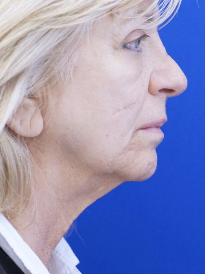 Jowls and Loose Neck Skin