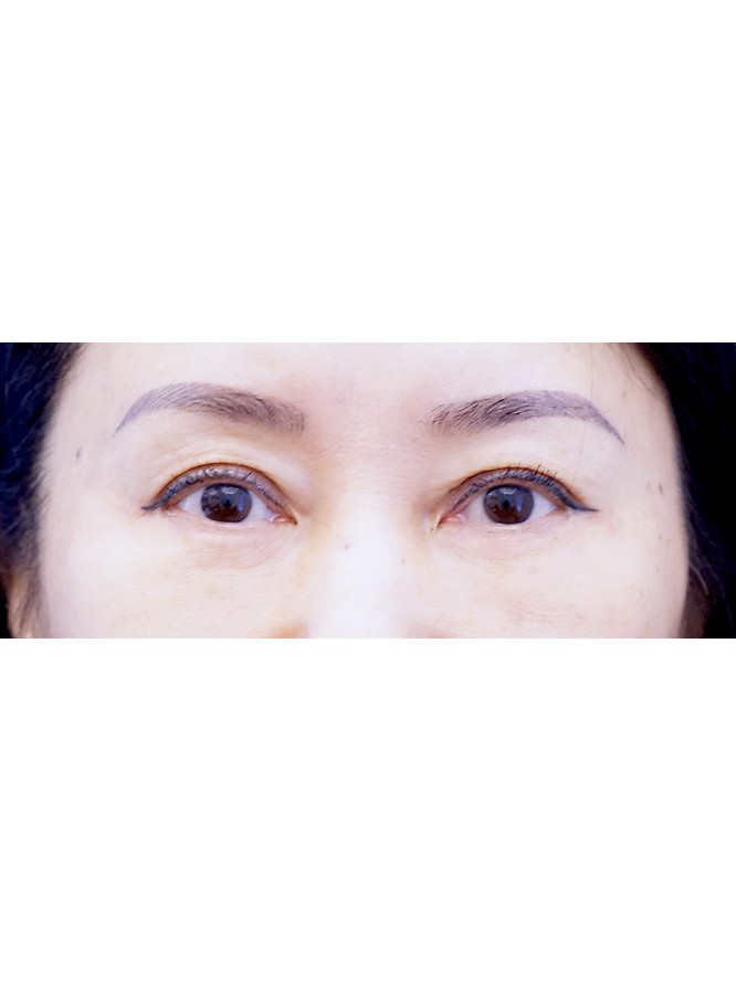 Lower Blepharoplasty with Fat Repositioning